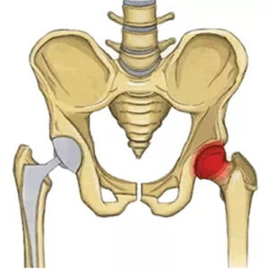 Physical Therapy After Hip Replacement Surgery