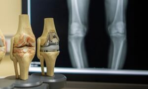 Why does knee prosthesis loosen?