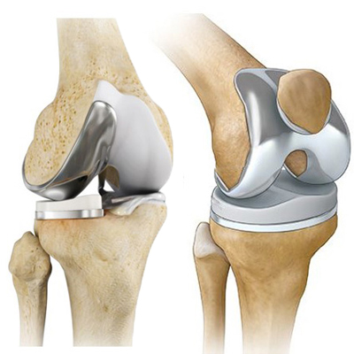 جراحة الركبة الاصطناعية في سن مبكرة