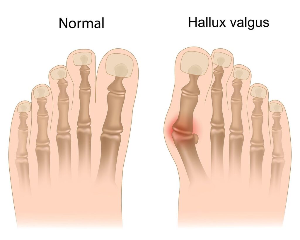 halluks valgus belirtileri