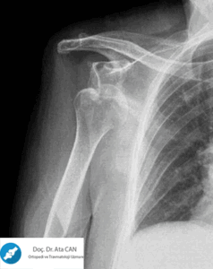 переломы плечевой кости