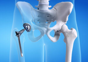 Hip Fracture Symptoms
