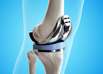 эндопротезирование коленного сустава