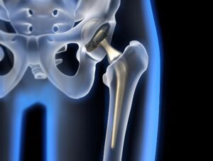 Hip Replacement Robotic Surgery