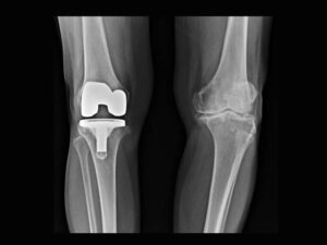 Robotic Knee Prosthesis Surgery Istanbul