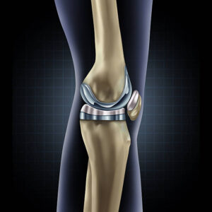 Robotic Knee Prosthesis Surgery Istanbul