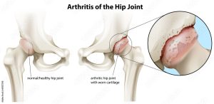 What Causes Hip Pain?
