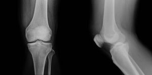 Robotic Knee Prosthesis Surgery