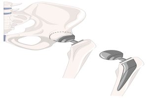 Robotic Hip Replacement Surgery
