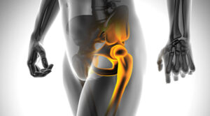 Hip Fracture Surgery in the Elderly