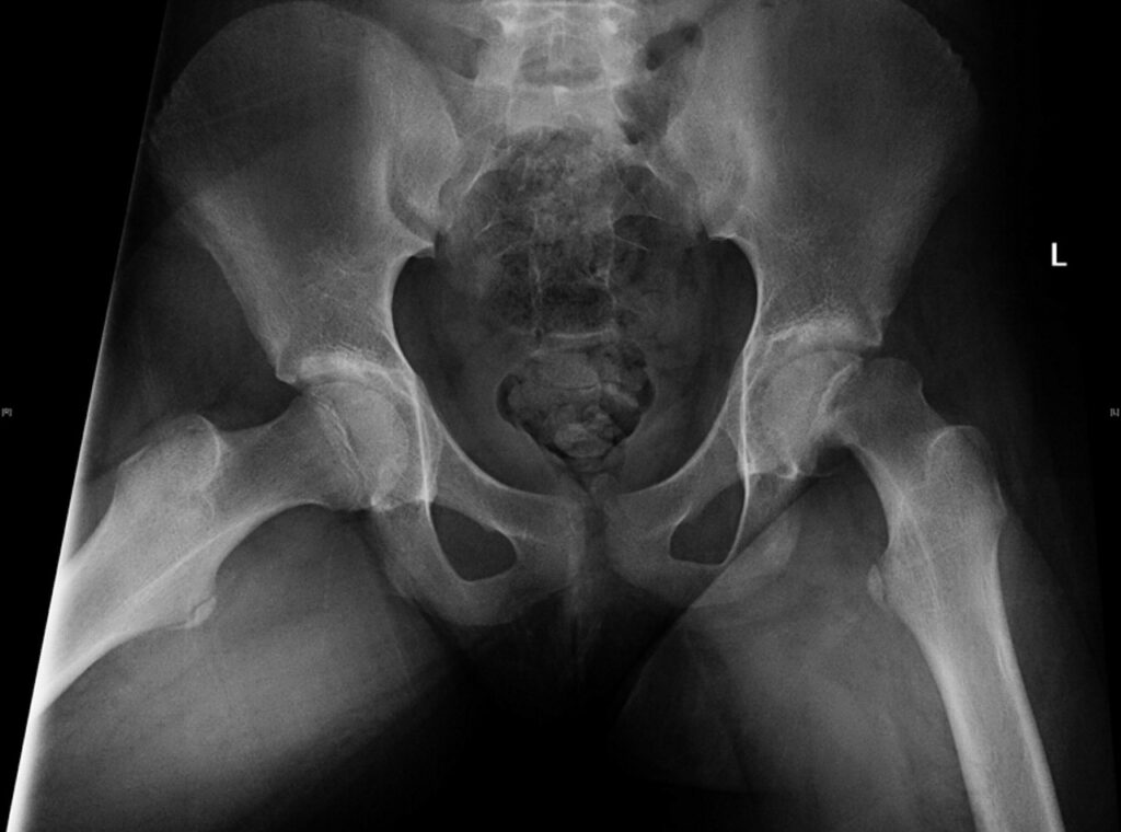 Kalça Çıkığı Tedavisi