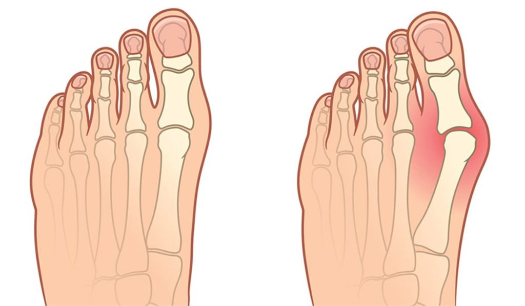 Ayak Baş Parmak Eğriliği (Halluks Valgus) Nedir?