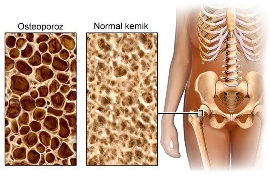 Osteoporoz: Kemik Erimesinin Nedenleri ve Belirtileri