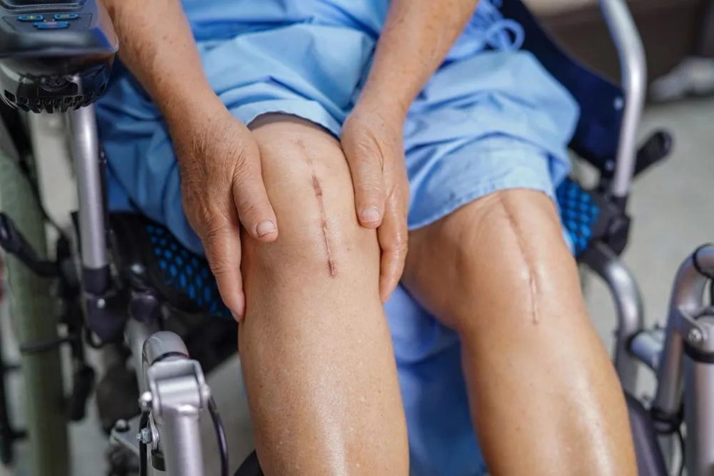 Robotik Diz Protezi Sonrası İyileşme Hızı: Gerçekten Hızlanabilir mi?