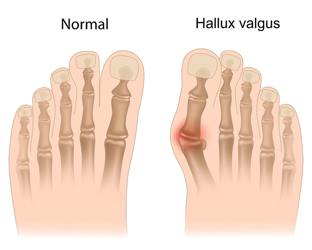 Ayak Sağlığını Bozan Sessiz Tehdit: Halluks Valgus ve Tedavisinde Yeni Yaklaşımlar
