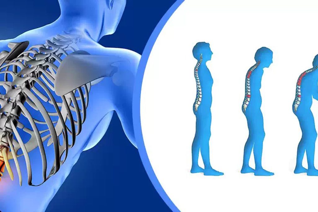 Osteoporozda Beslenme ve Egzersizin İyileştirici Gücü: Kemiklerinizi Nasıl Korursunuz?