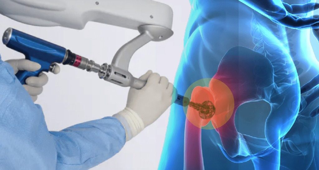 Teknolojinin Cerrahideki Zirvesi: Robotik Kalça Protezi ve Geleneksel Yöntemlerden Farkları