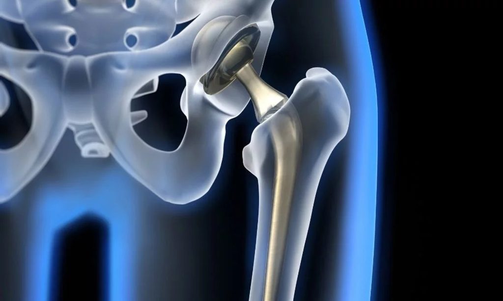 Robotik Kalça Cerrahisi: Daha Az Ağrı ve Hızlı İyileşme ile Hareket Özgürlüğüne Dönüş