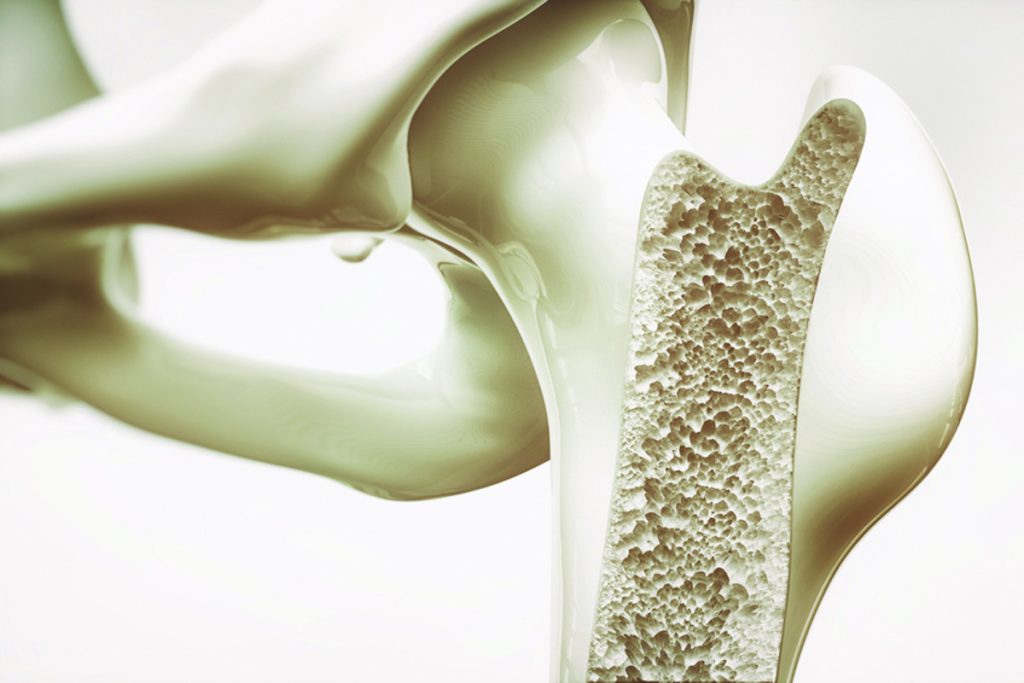 Sessiz İlerleyen Tehlike: Kemik Erimesi (Osteoporoz) ve Bilinmesi Gerekenler
