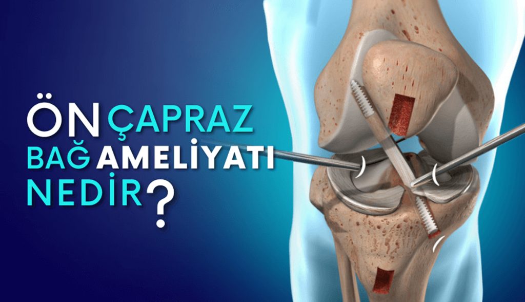 ACL Ameliyatı Ne Zaman Gerekir? Kopan Bağ İçin Doğru Zamanlama ve Karar Süreci