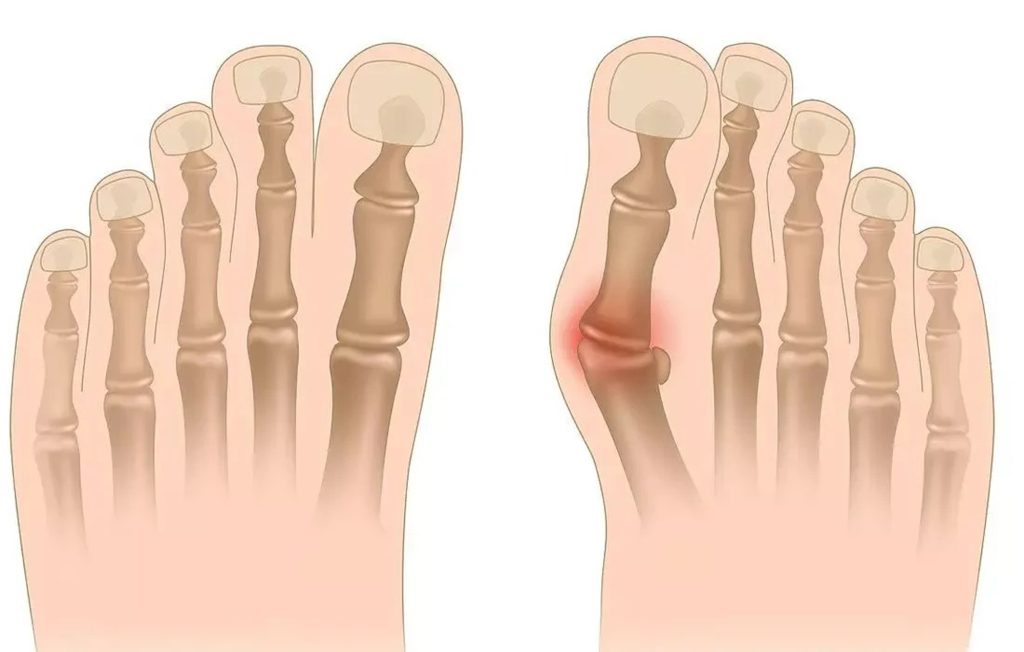 Halluks Valgus