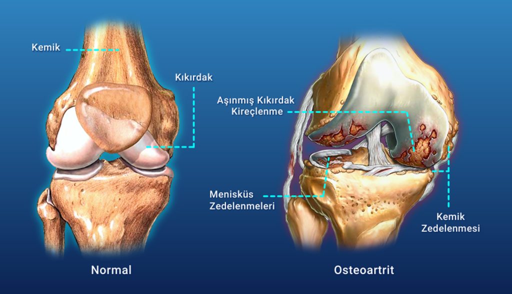 Kireçlenme (Osteoartrit) Nedir? Belirtileri Nelerdir?