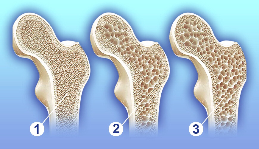 Osteoporoz Kimlerde Daha Sık Görülür?