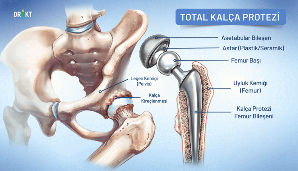 Robotik Kalça Protezi