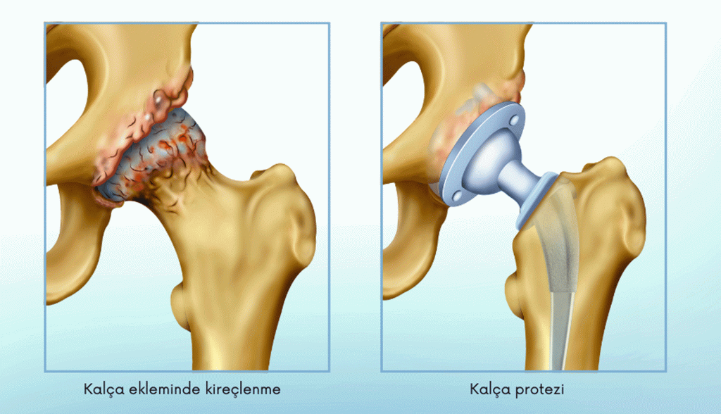Robotik Kalça Protezi