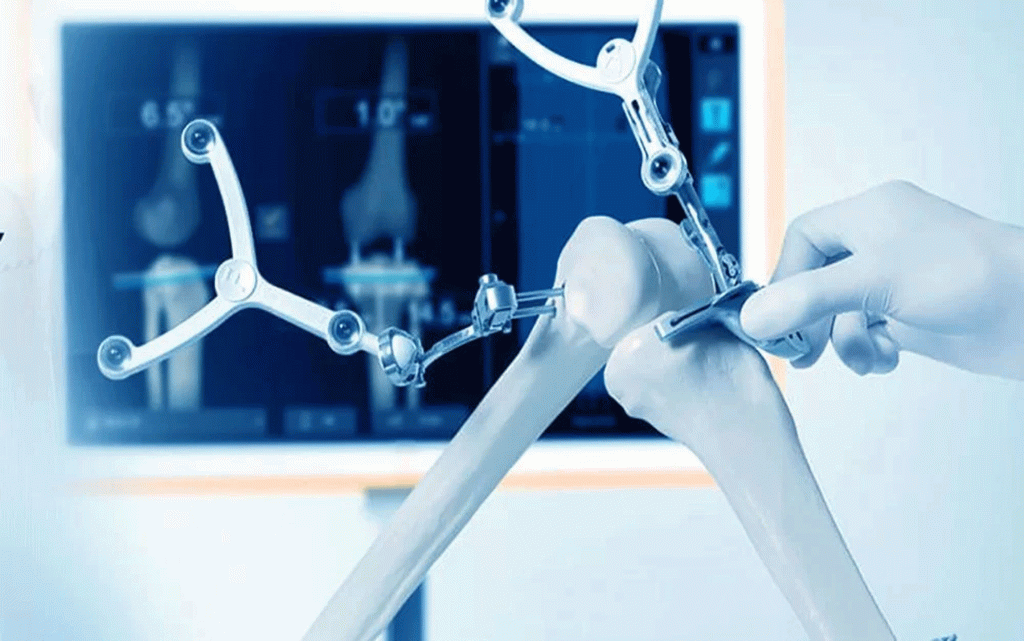 Robotik Diz Protezi Ameliyatı Nasıl Yapılır?