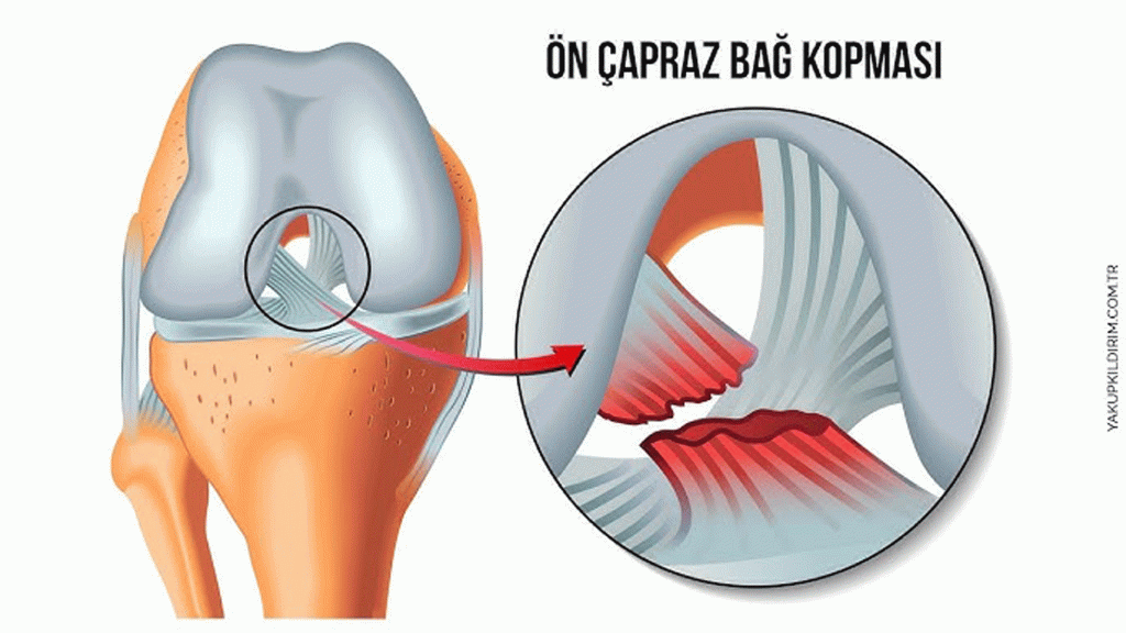 Ön Çapraz Bağ Kopması Tedavi Edilmezse Ne Olur?