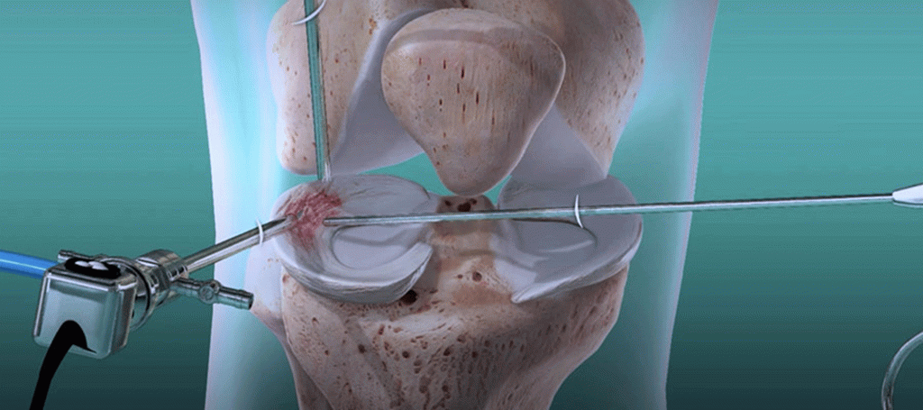 Diz Osteoartritinde Protez Ameliyatı Ne Zaman Gerekli?