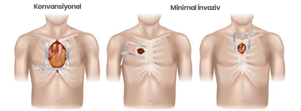 Minimal İnvaziv Kalça Protezi Cerrahisi: Avantajlar ve Sınırlılıklar