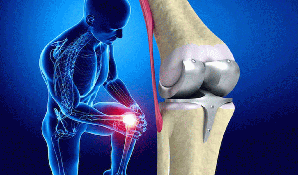 Parsiyel Diz Protezi mi Total Diz Protezi mi? Klinik Karşılaştırma