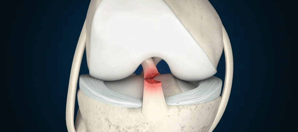 Menisküs Yırtığı Nedir? Belirtileri Nelerdir?