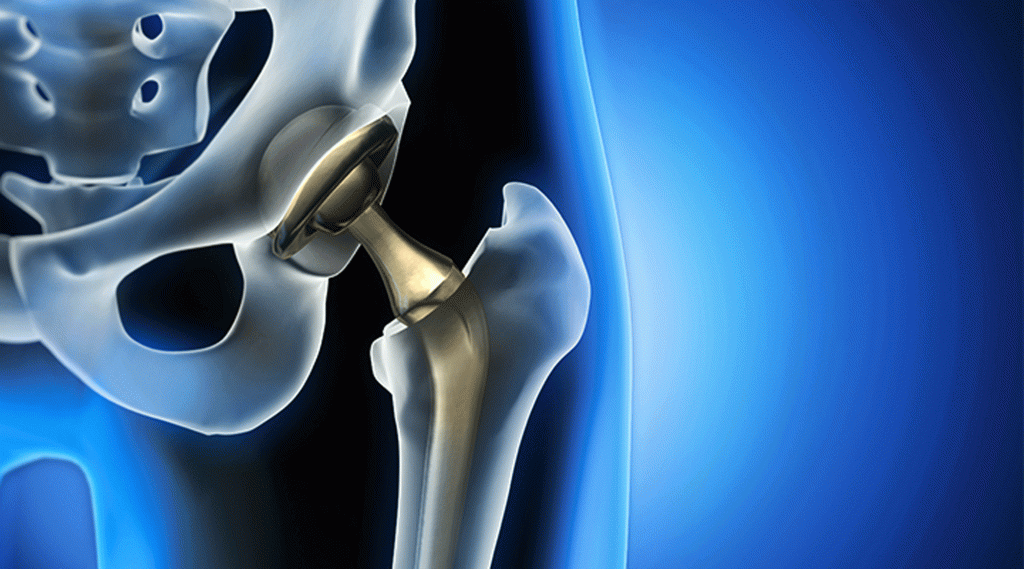 Robotik Destekli Kalça Protezi: Komplikasyon Oranları Azalıyor mu?
