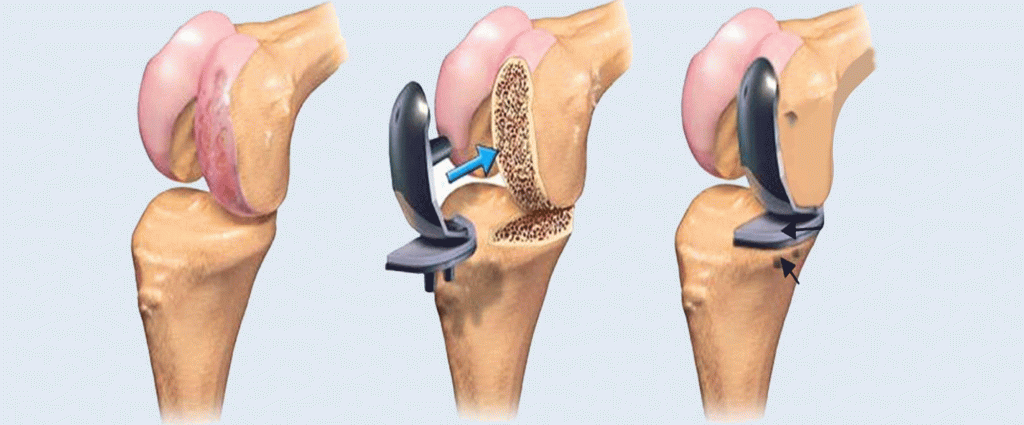 Total Diz Artroplastisinde Robotik Teknolojinin Klinik Katkısı
