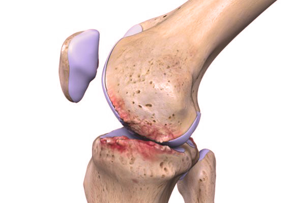 Diz Osteoartritinde Protez Ameliyatı Ne Zaman Gerekli?