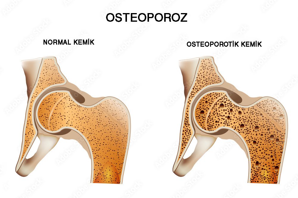 Osteoporoz Tedavisinde Güncel Yöntemler
