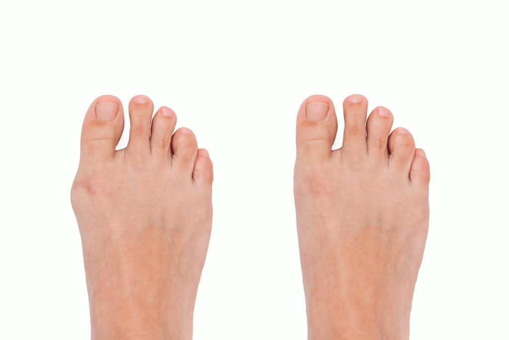 Halluks Valgus Tedavi Edilmezse Ne Olur?