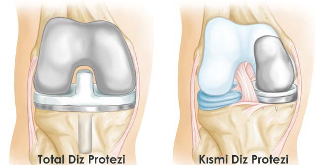 Total Diz Artroplastisinde Robotik Teknolojinin Klinik Katkısı